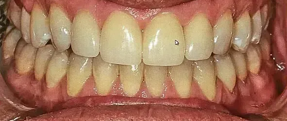 After Porcelain Crowns
