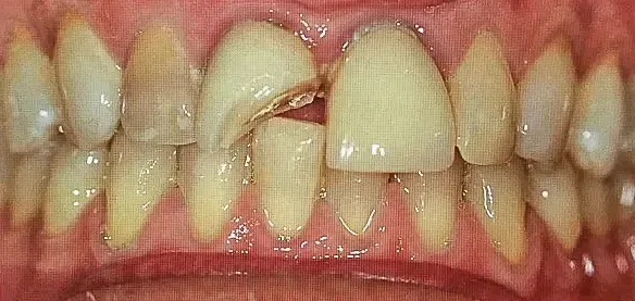 Before Porcelain Crowns