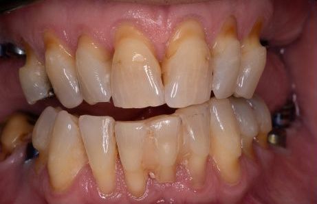 Before Porcelain Veneers