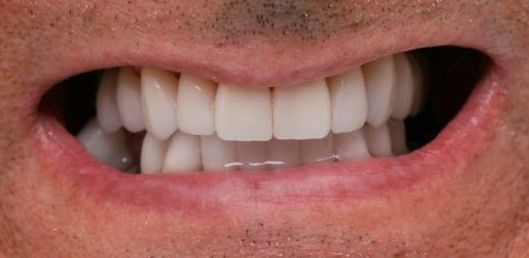 After Porcelain Veneers