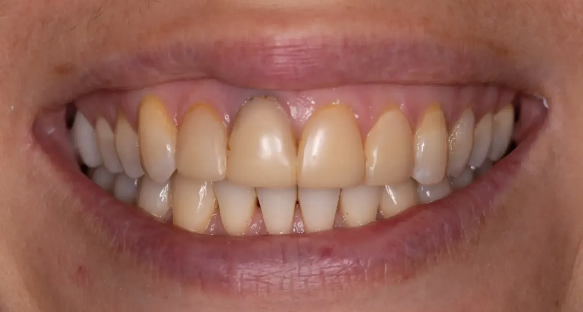 Before Porcelain veneers