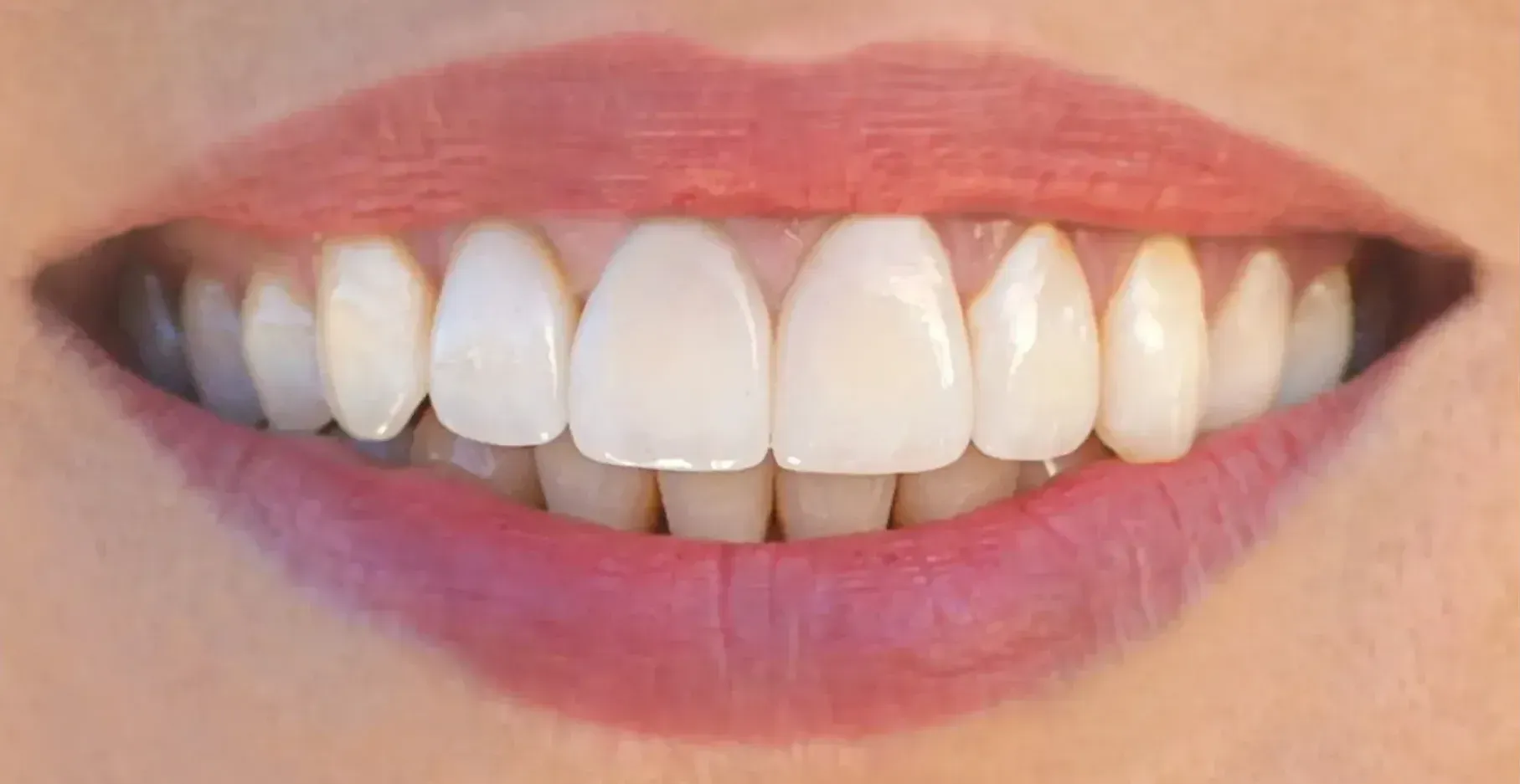 After Porcelain veneers