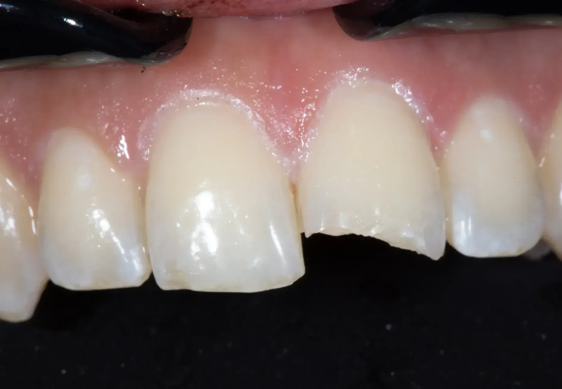 Before Restoration of Tooth With Composite Bonding