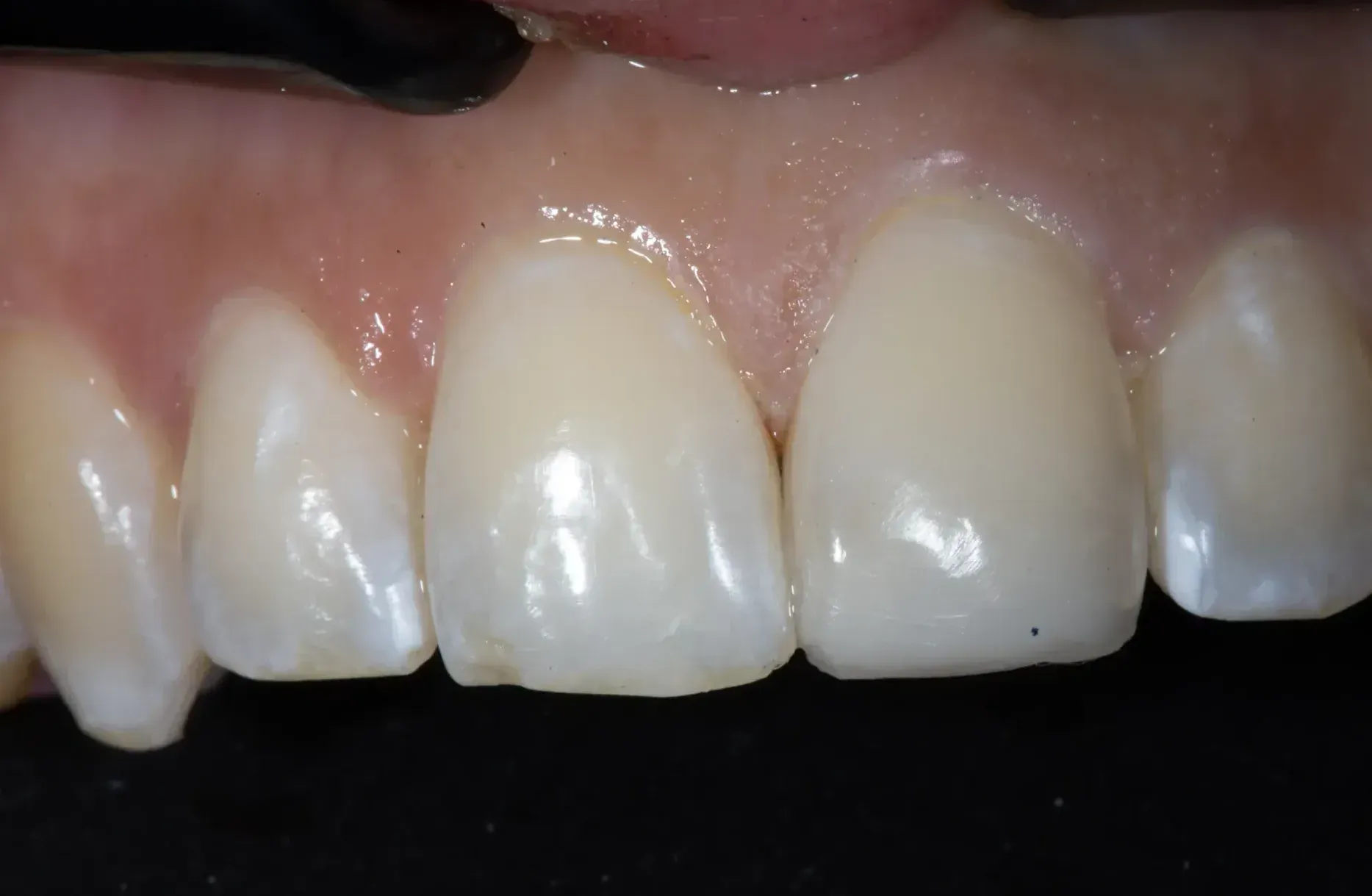 After Restoration of Tooth With Composite Bonding