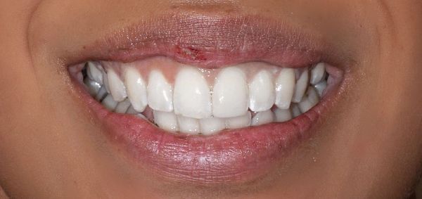 After Single Chipped Tooth