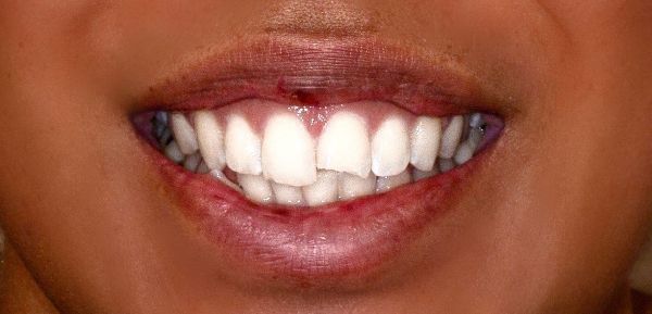 Before Single Chipped Tooth