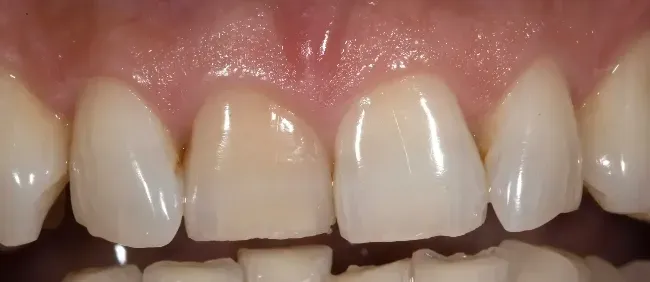 Before Single Tooth Whitening