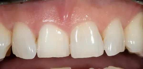 After Single Tooth Whitening