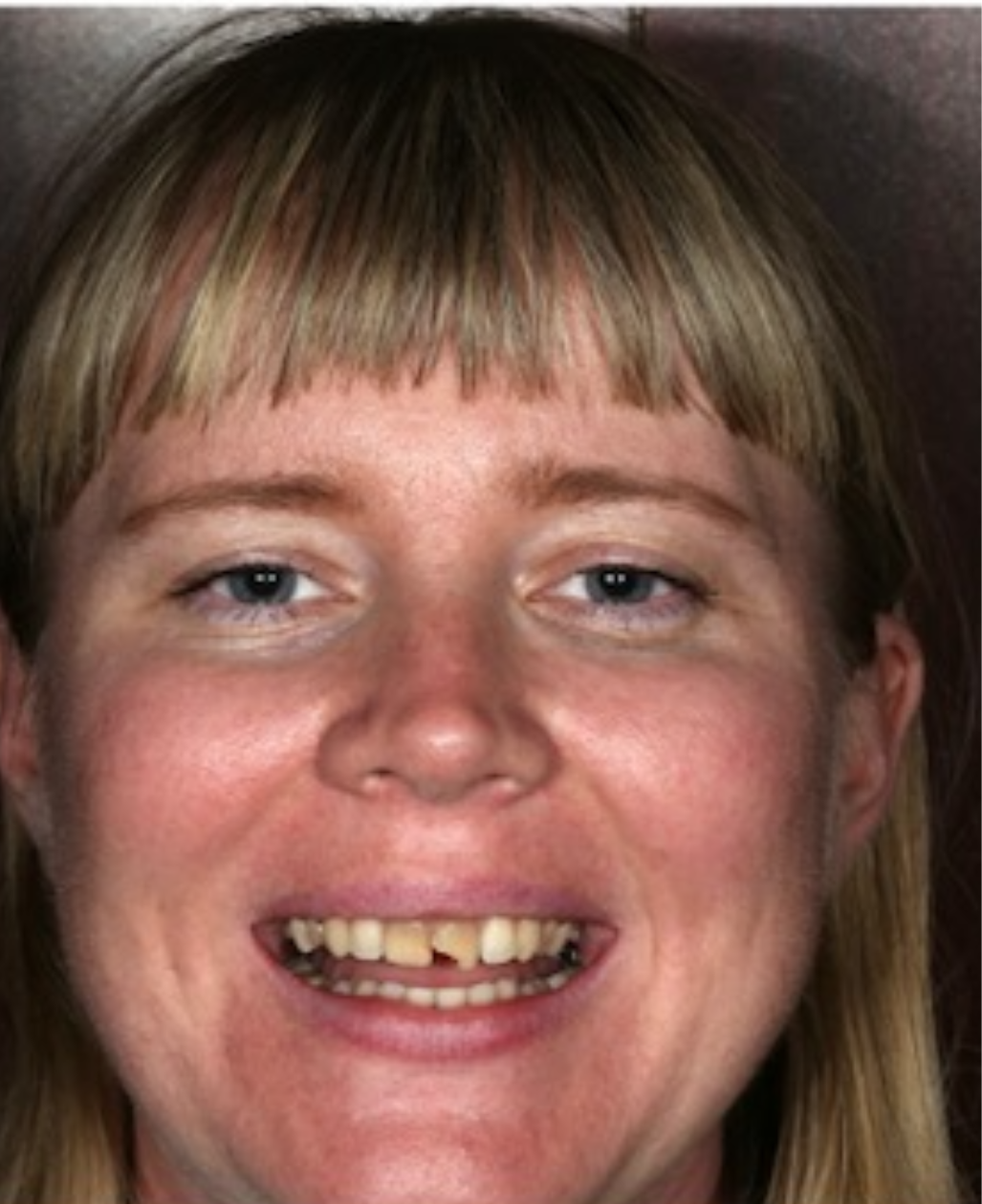 After Full-Mouth Reconstruction