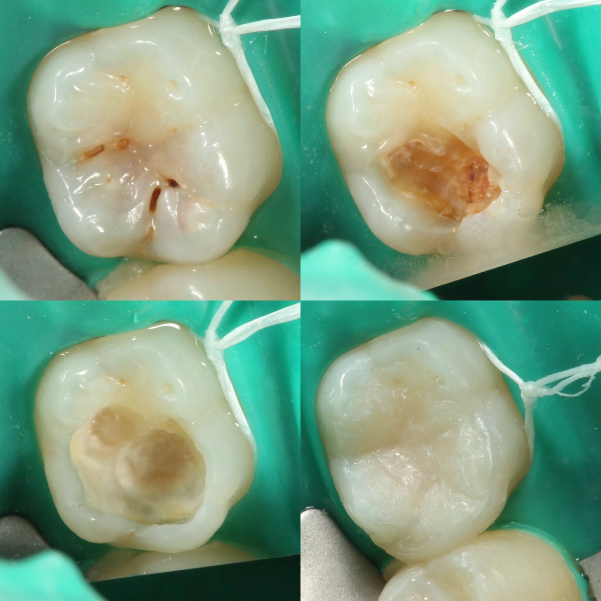Cavity Filling