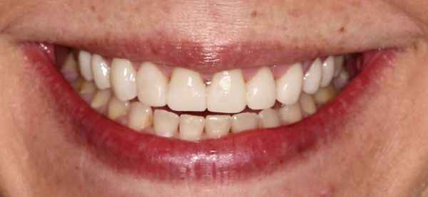 After Full-Mouth Reconstruction