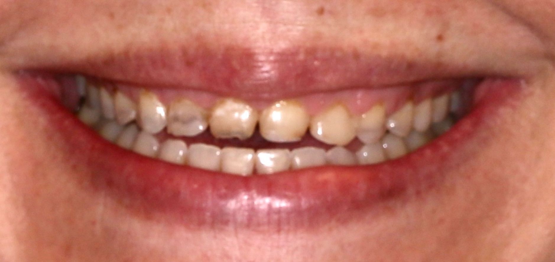 Before Full-Mouth Reconstruction