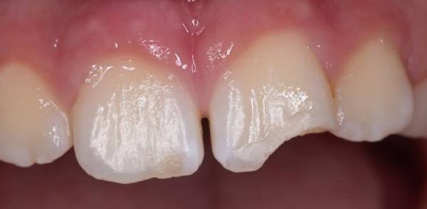 Before Chipped Tooth Repaired
