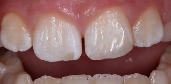 After Chipped Tooth Repaired