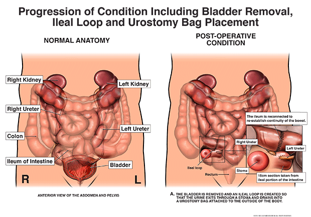 Abdomen and Pelvis — Cincinnati, OH — Litigation Support Services