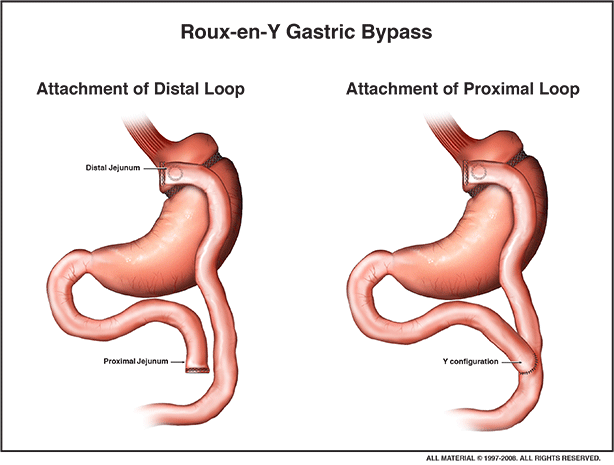 Gastric Bypass — Cincinnati, OH — Litigation Support Services