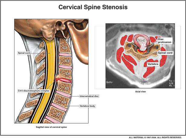 Cervical Spine — Cincinnati, OH — Litigation Support Services