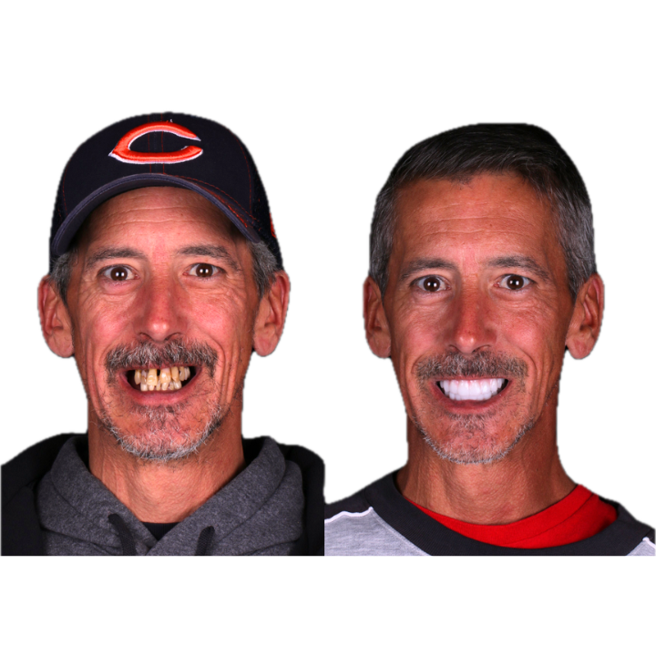 Before and after dental photo: Man smiles with crooked teeth then with a bright, new smile.
