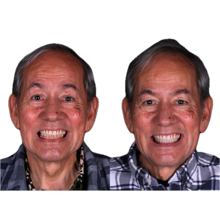 Two close-up portraits of a man smiling with improved teeth. The right image shows a brighter smile.