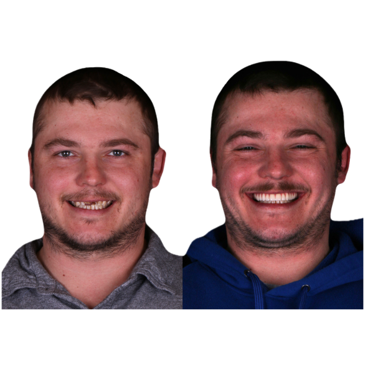 Side-by-side comparison: Man with missing teeth (left) and smiling with new teeth (right).