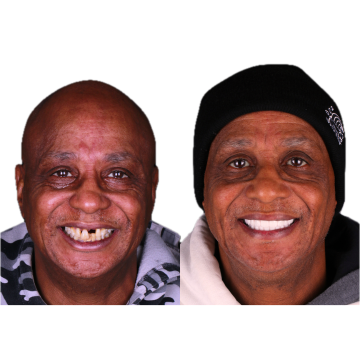 Side-by-side comparison: Man with missing teeth and then smiling with bright, white teeth after dental work.