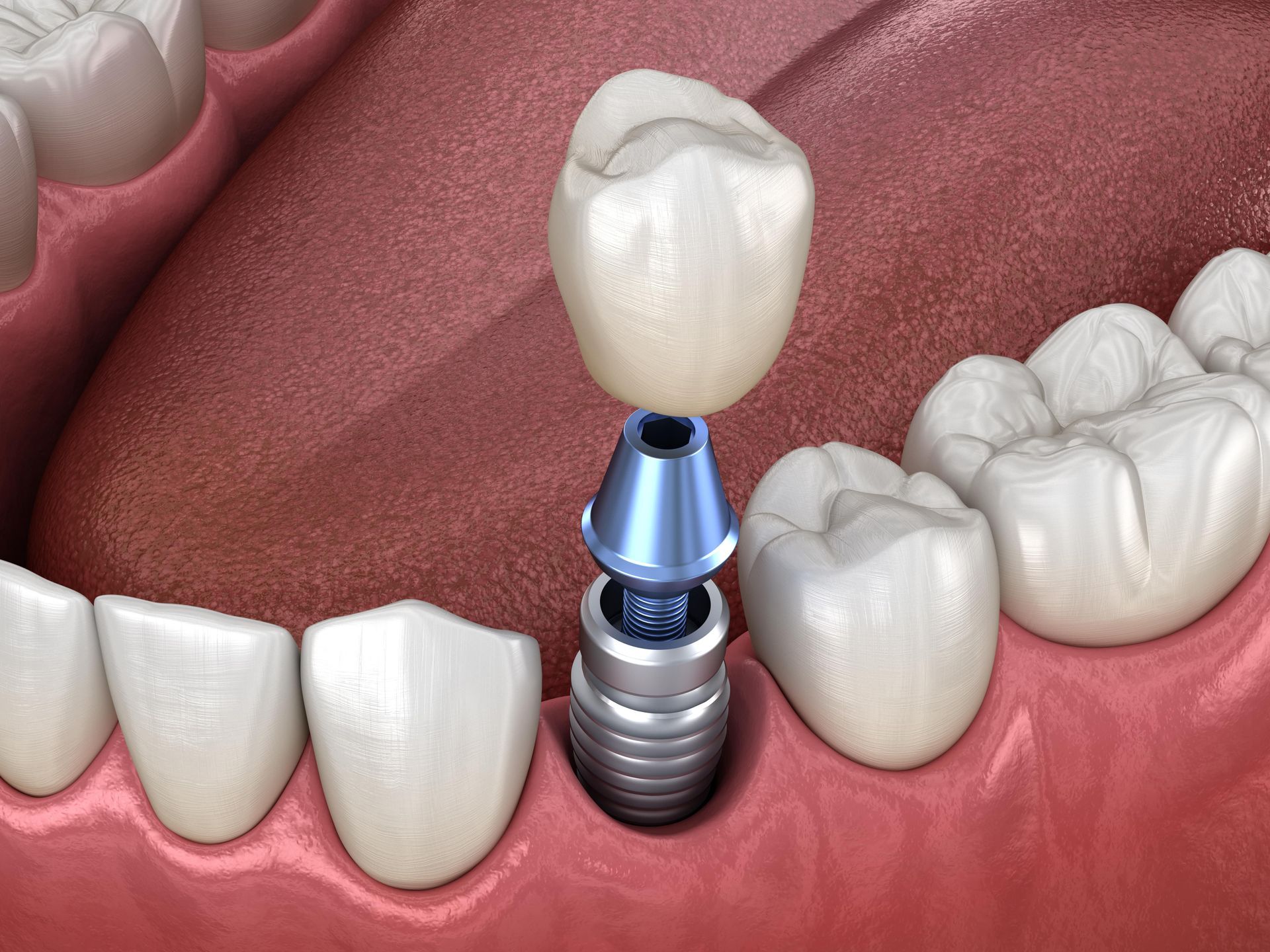 Dental implant components: screw, abutment, and crown fitting into an open mouth.
