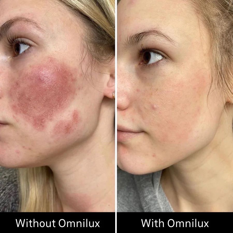 Omnibus Contour LED Light Therapy