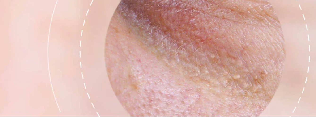 Dark Circles + Under-Eye Bags