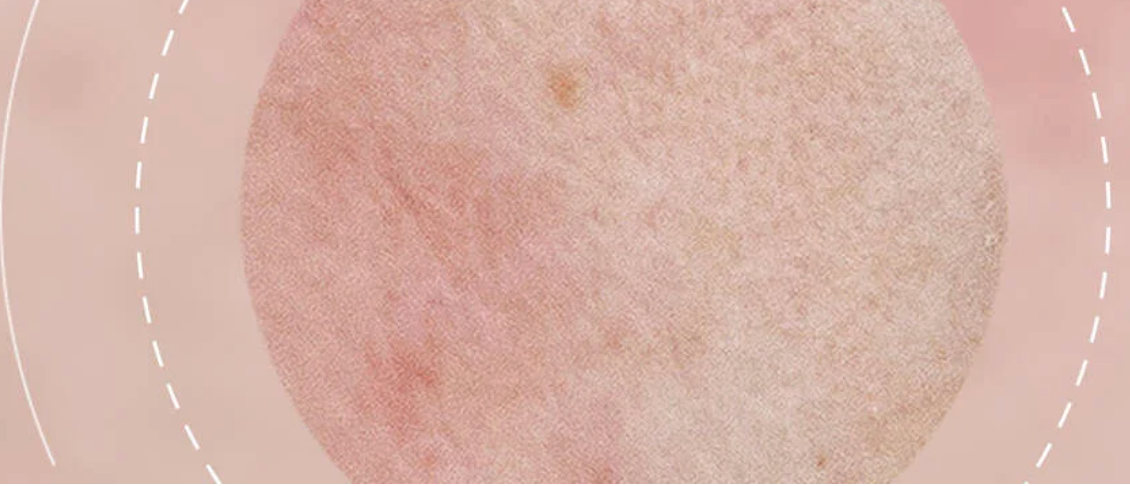 Skincare for Sensitivity