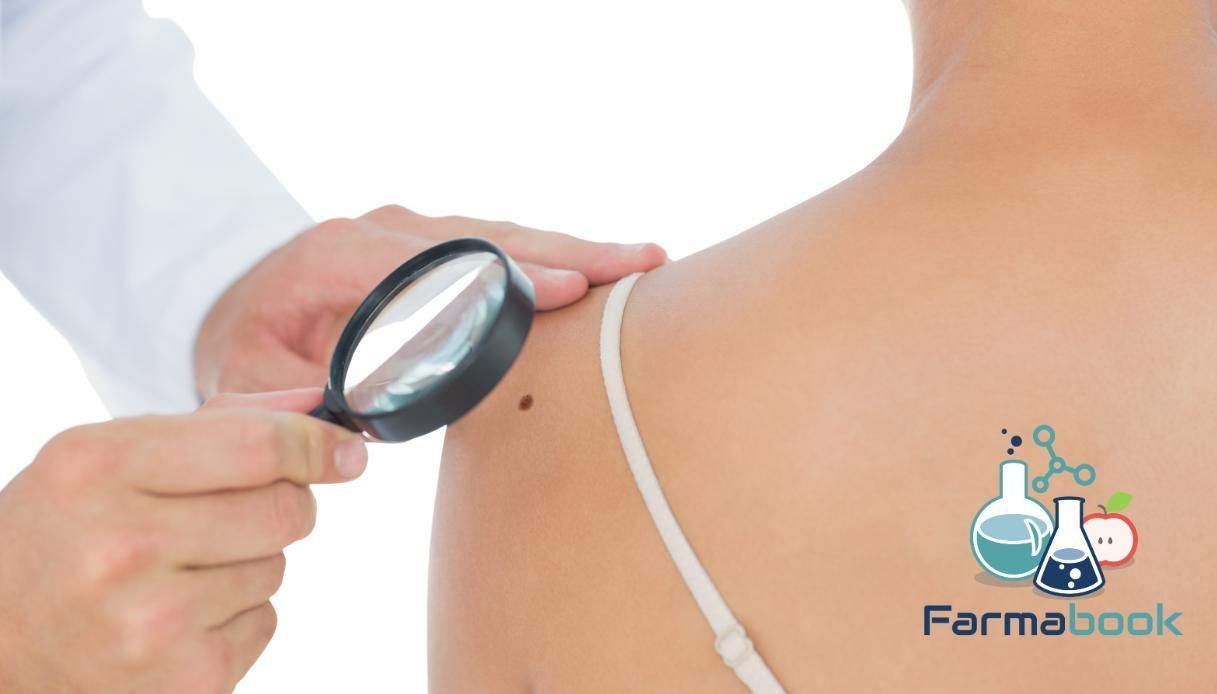Melanoma: cos'è e tutto ciò che c'è da sapere