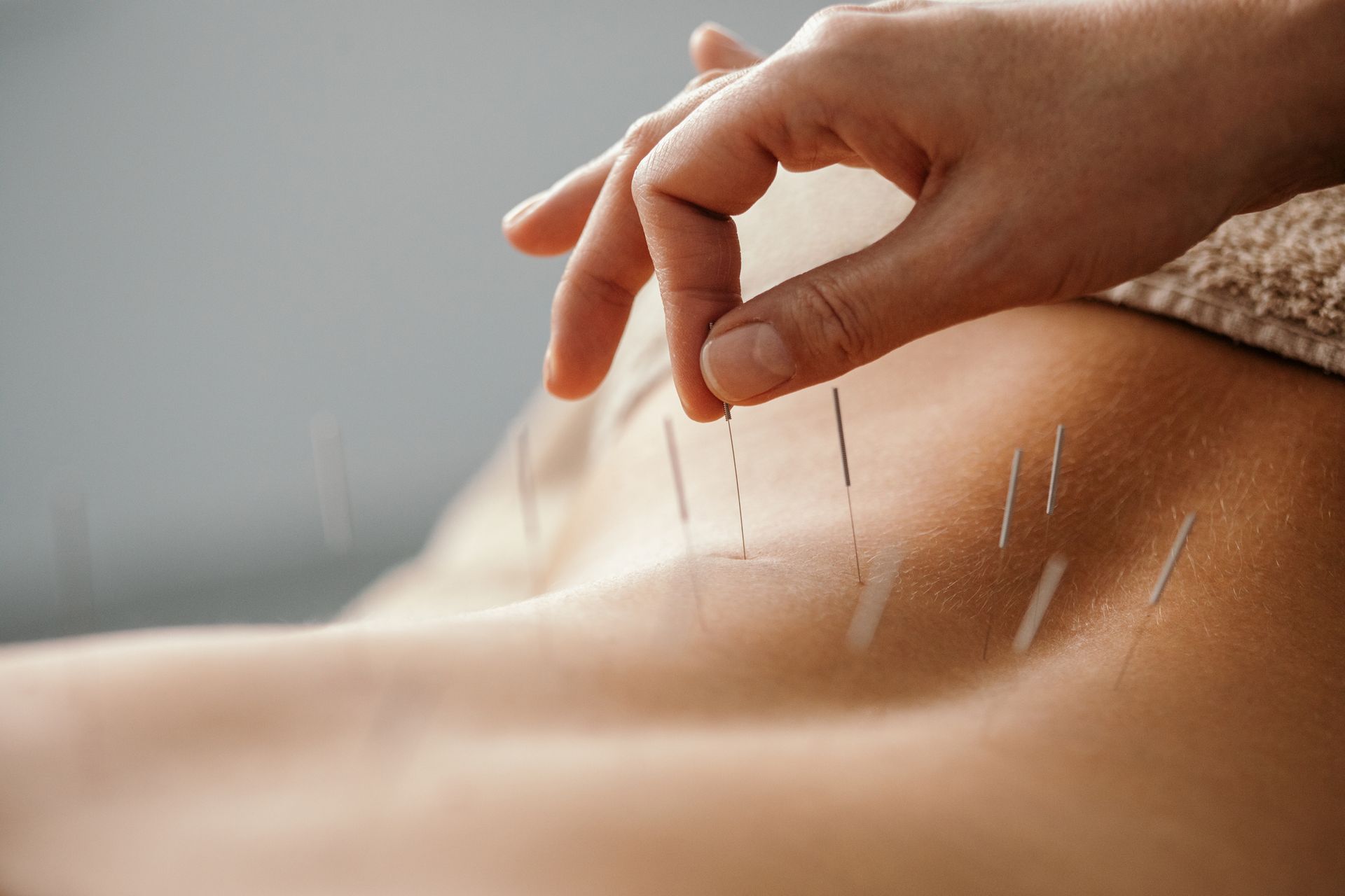A person is getting acupuncture on their back.