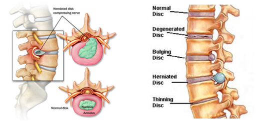 Anatomical depiction of a disc bulge in the human spine