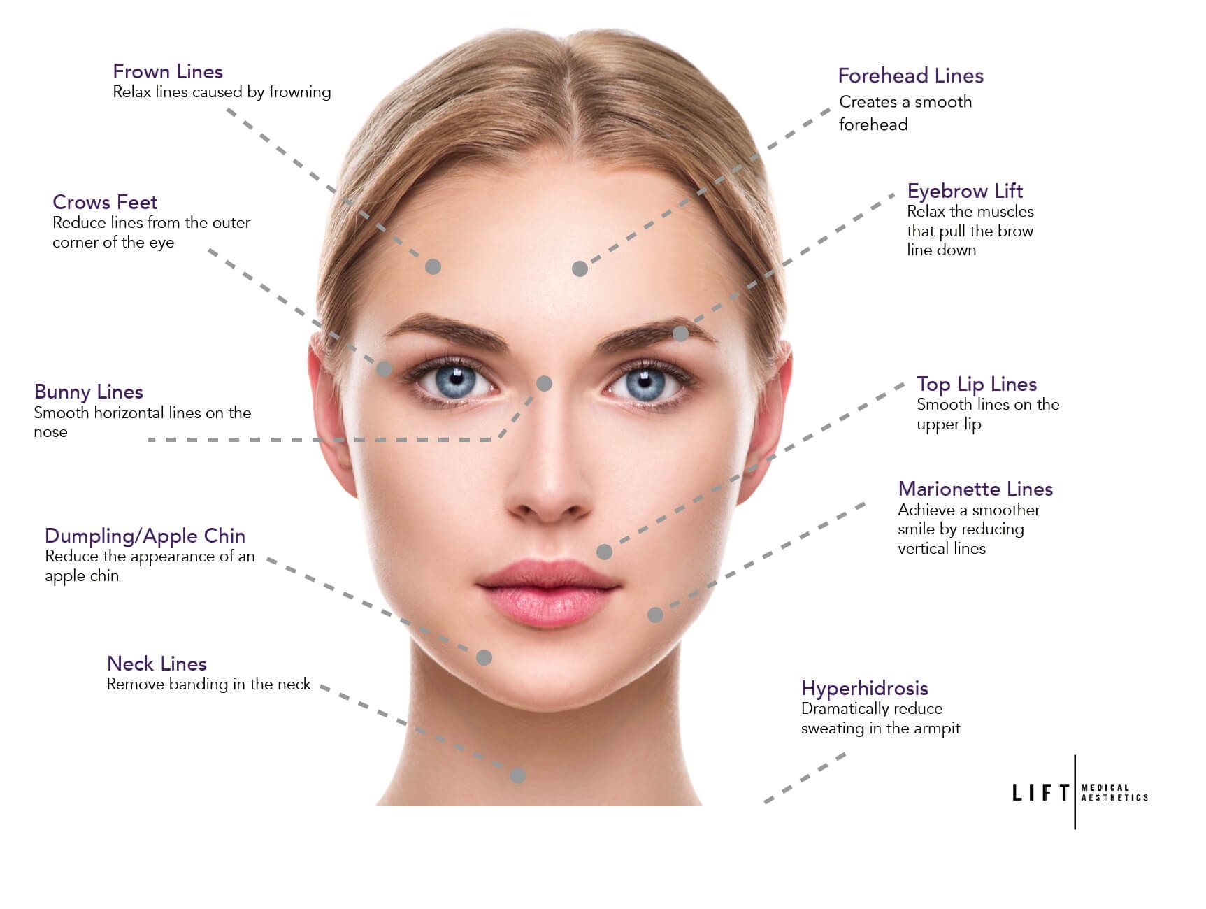 A black and white drawing of a woman 's face with different types of wrinkles.