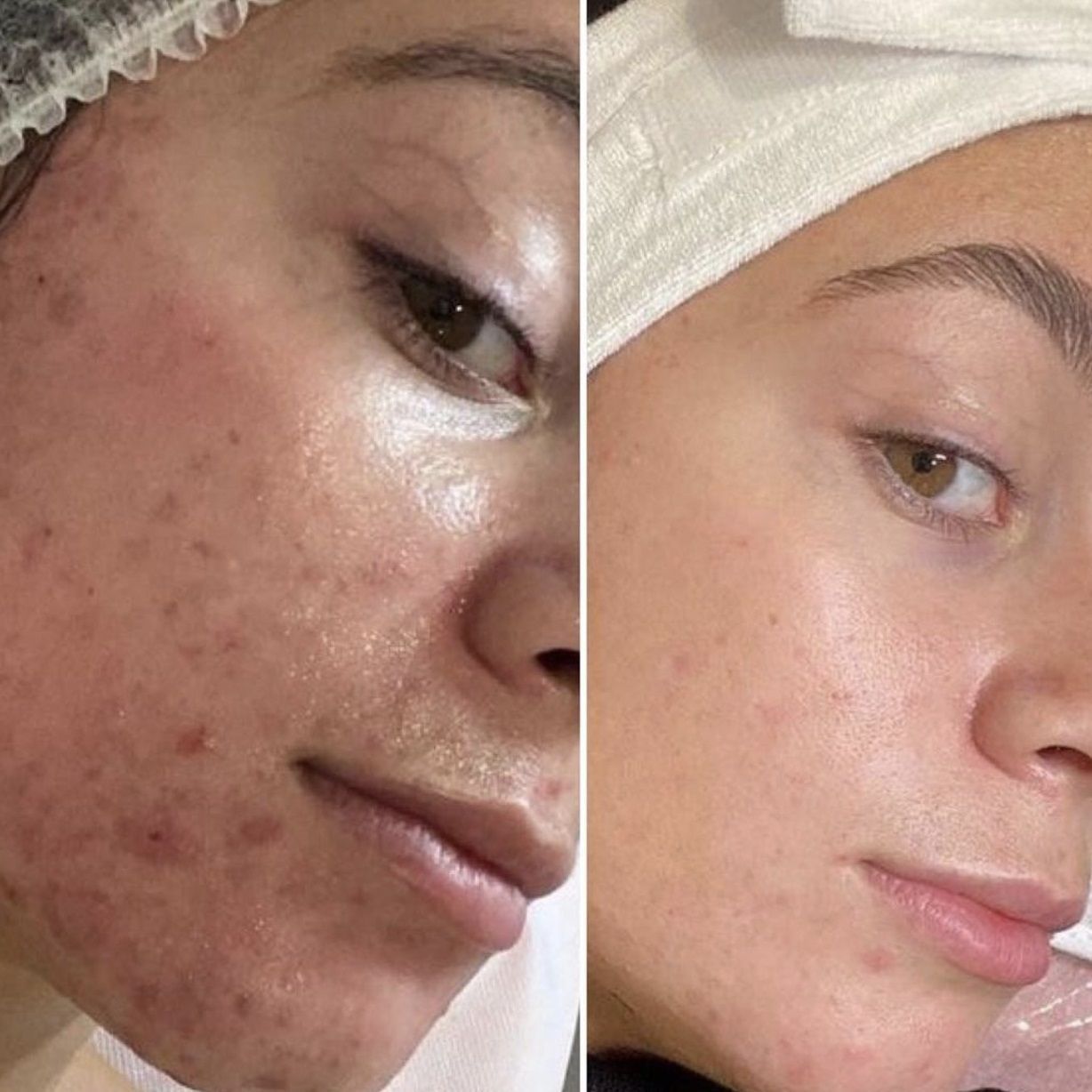 A black and white photo of a woman 's face before and after a treatment.