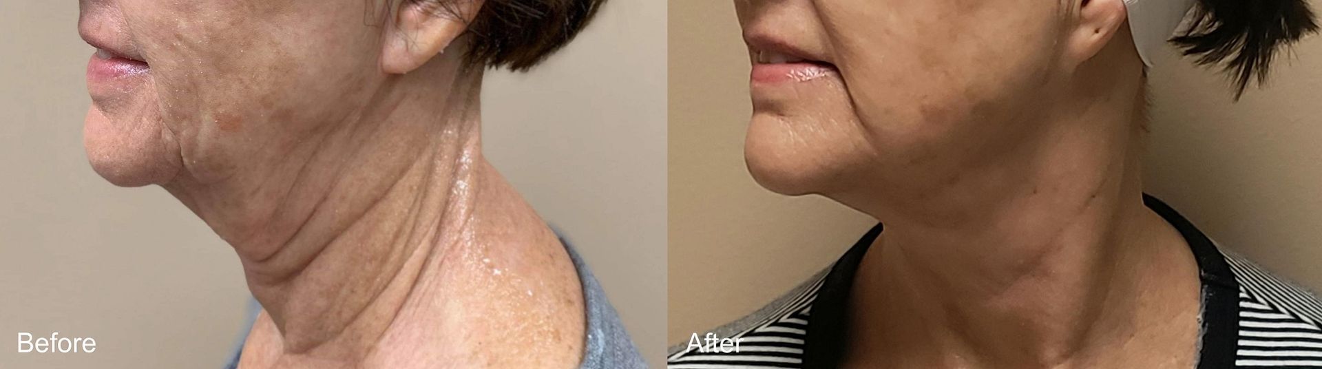 A before and after photo of a woman 's neck and face.