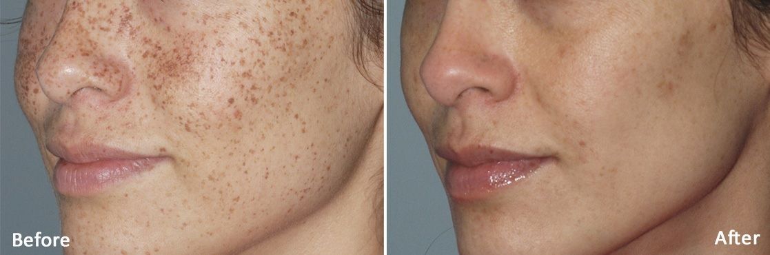 A before and after photo of a woman 's face