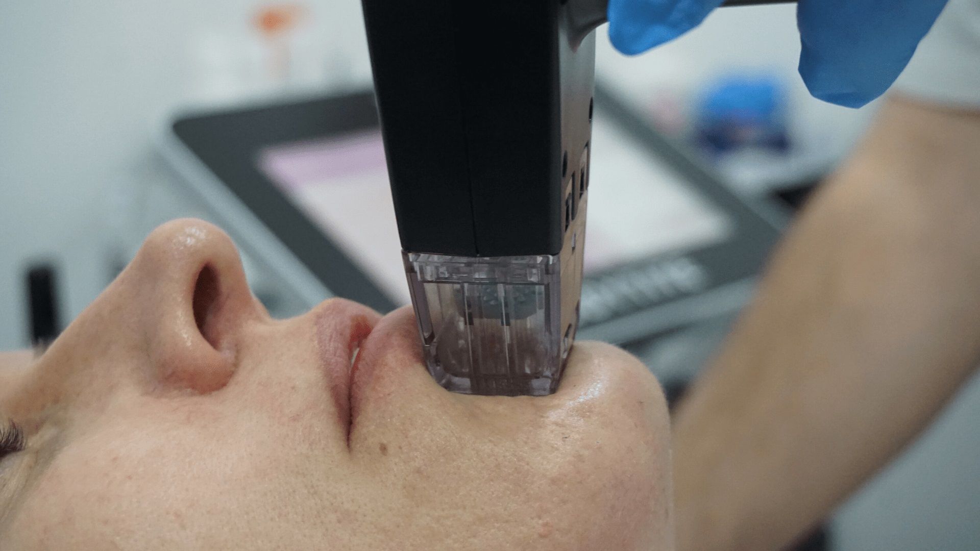 A black and white photo of a woman getting a laser treatment on her face.