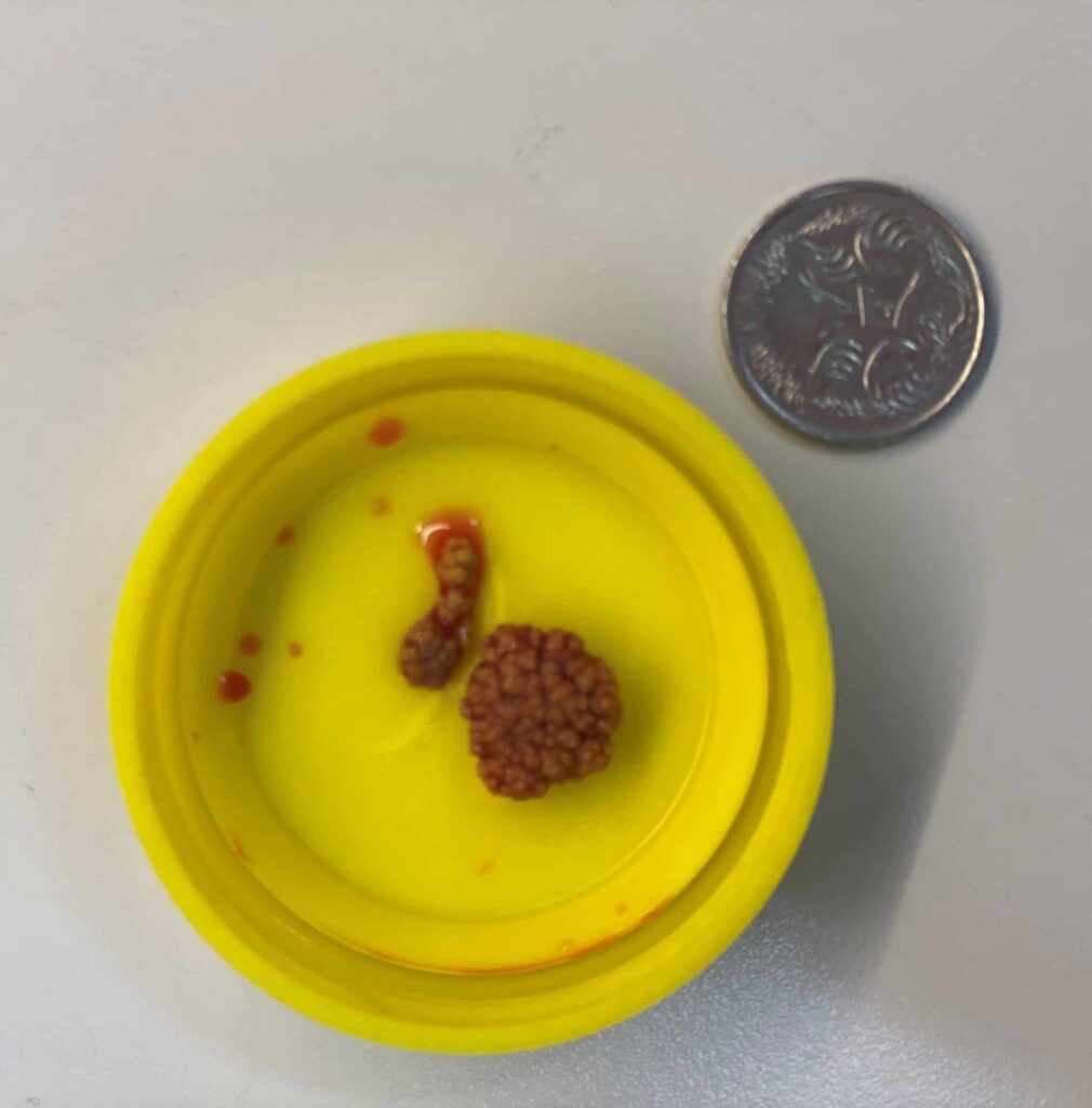 Two brown gallstones and a quarter coin in a yellow container.