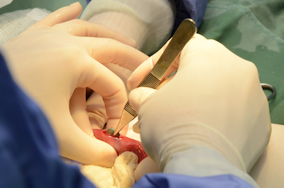 Hands in gloves performing surgery with surgical instruments on tissue.