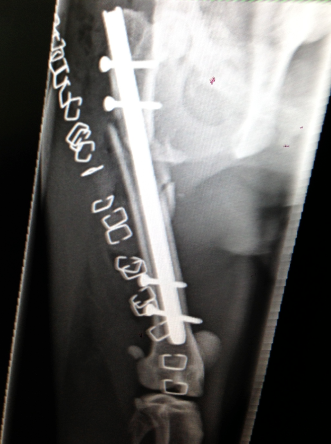 X-ray of a leg with a metal rod and screws inserted for bone stabilization, possibly after a fracture.