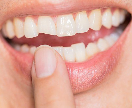 Close woman's teeth after dental bonding