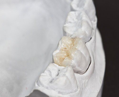 Stone model of teeth