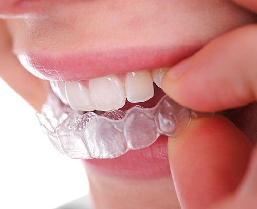 A close up of woman inserting Invisalign treys in Land O' Lakes FL