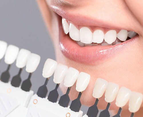 Close up of woman's teeth and teeth shade guide