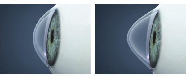 tipologie di lenti a contatto