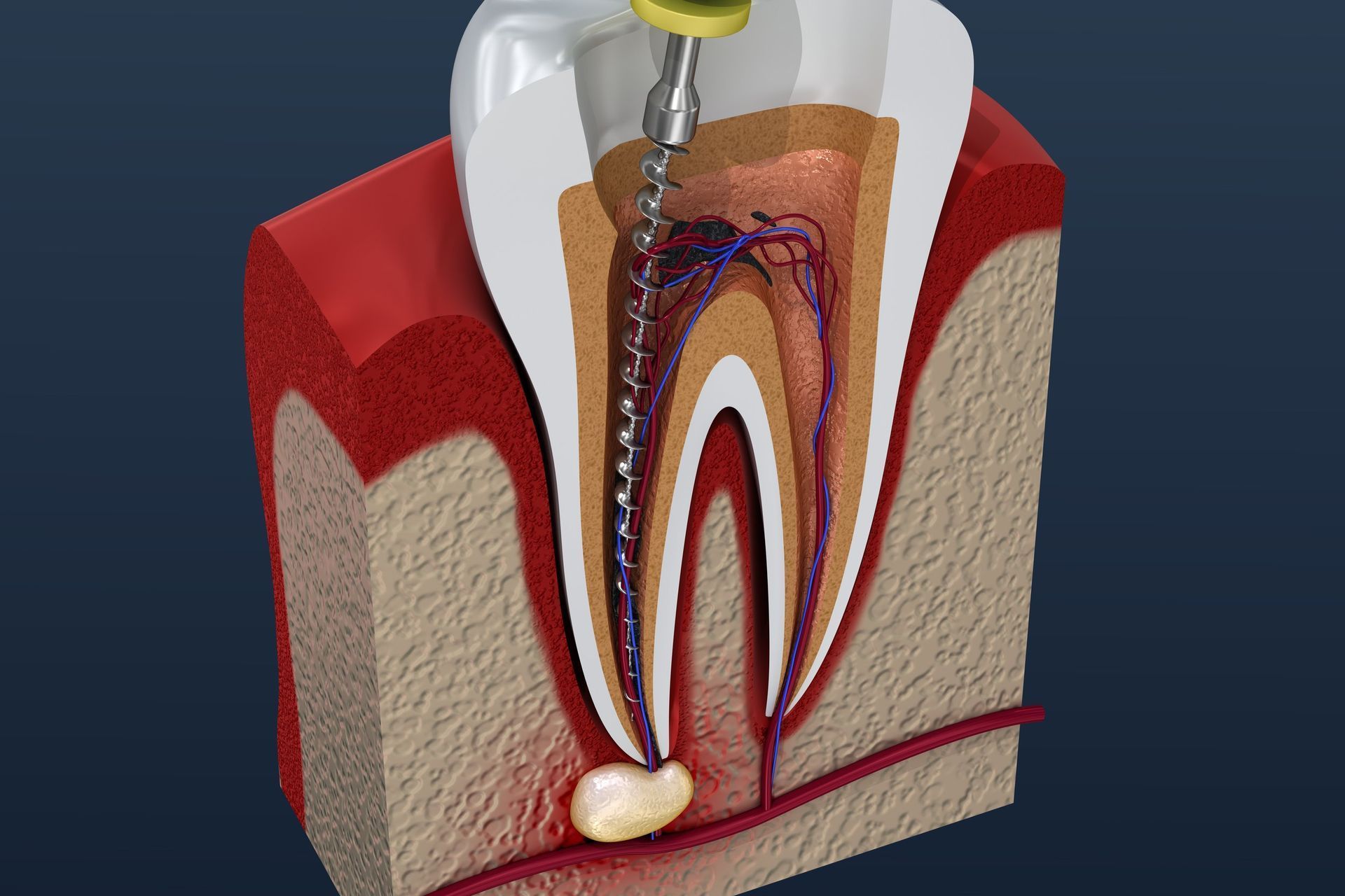 A 3D Model of a Tooth Being Extracted With a Drill — New Leaf Dentists in Erina, NSW