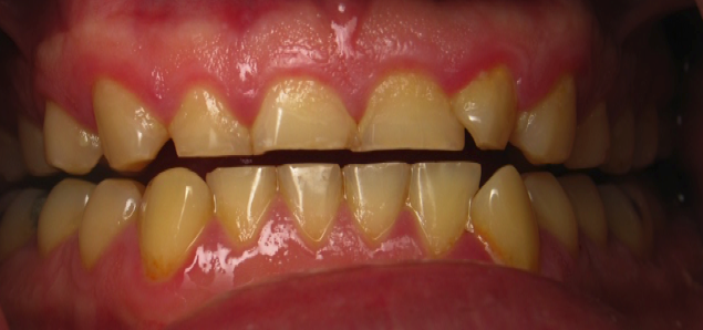 A Close Up of a Person's Teeth With Yellow Spots on Them — New Leaf Dentists in Erina, NSW