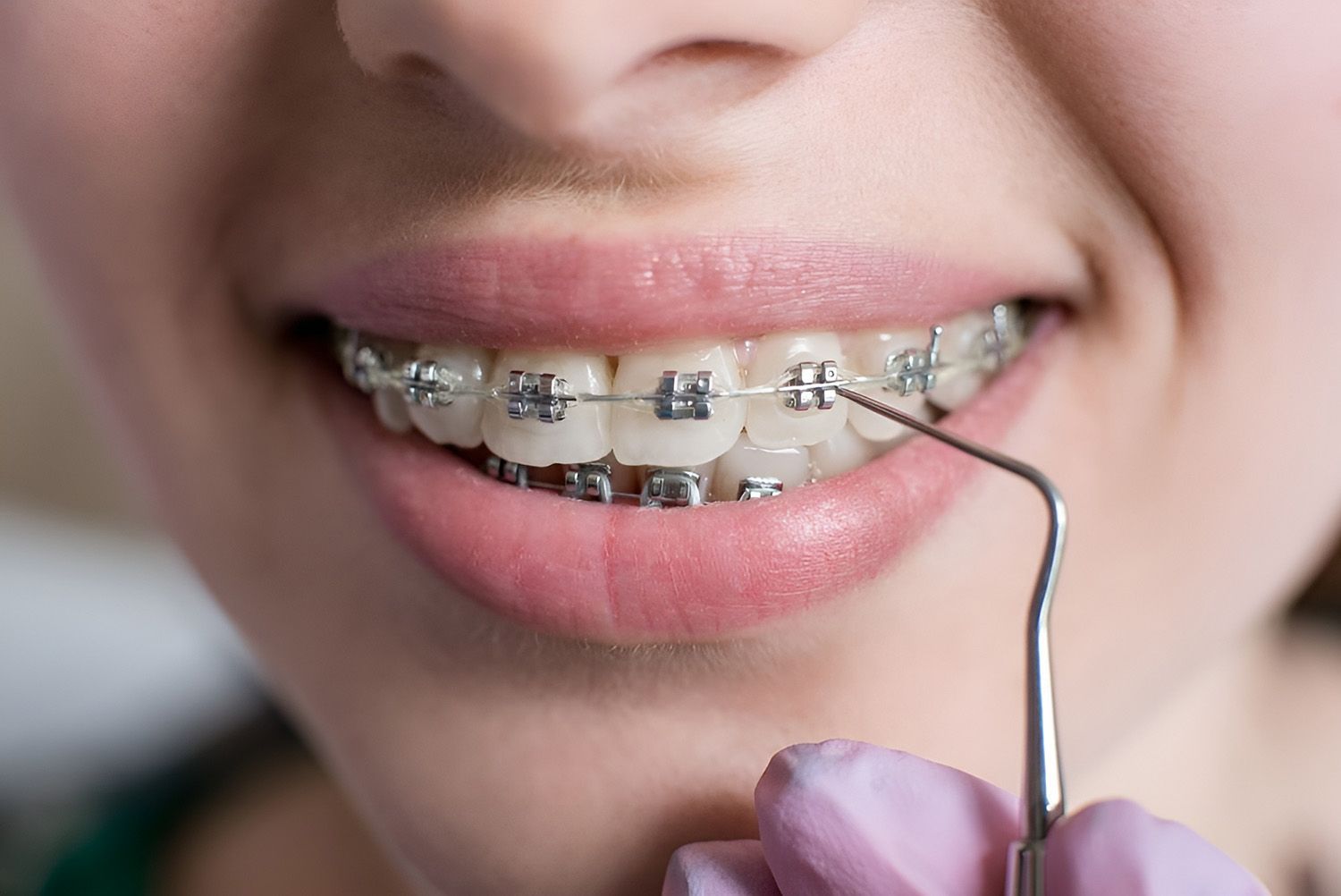 A Dentist Uses A Dental Instrument To Adjust Metal Braces