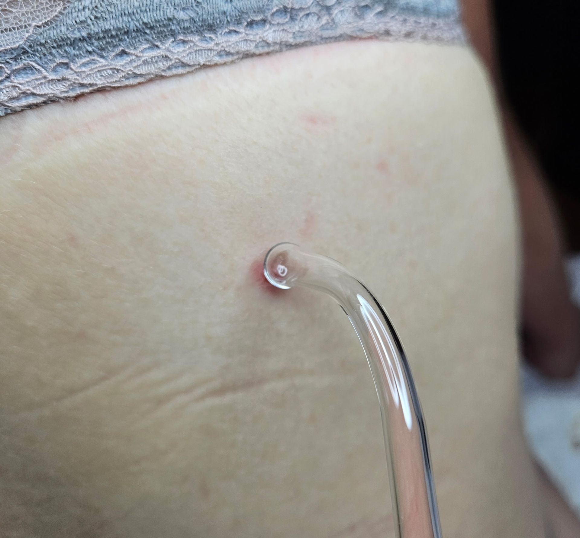Glass wand near skin, possibly for a beauty treatment. A small, raised spot is visible.