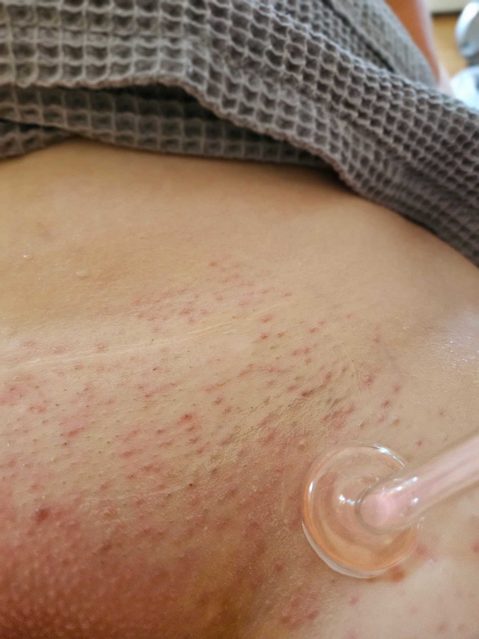 Person's skin with red marks, possibly after a skin treatment, and a glass wand touching the skin.